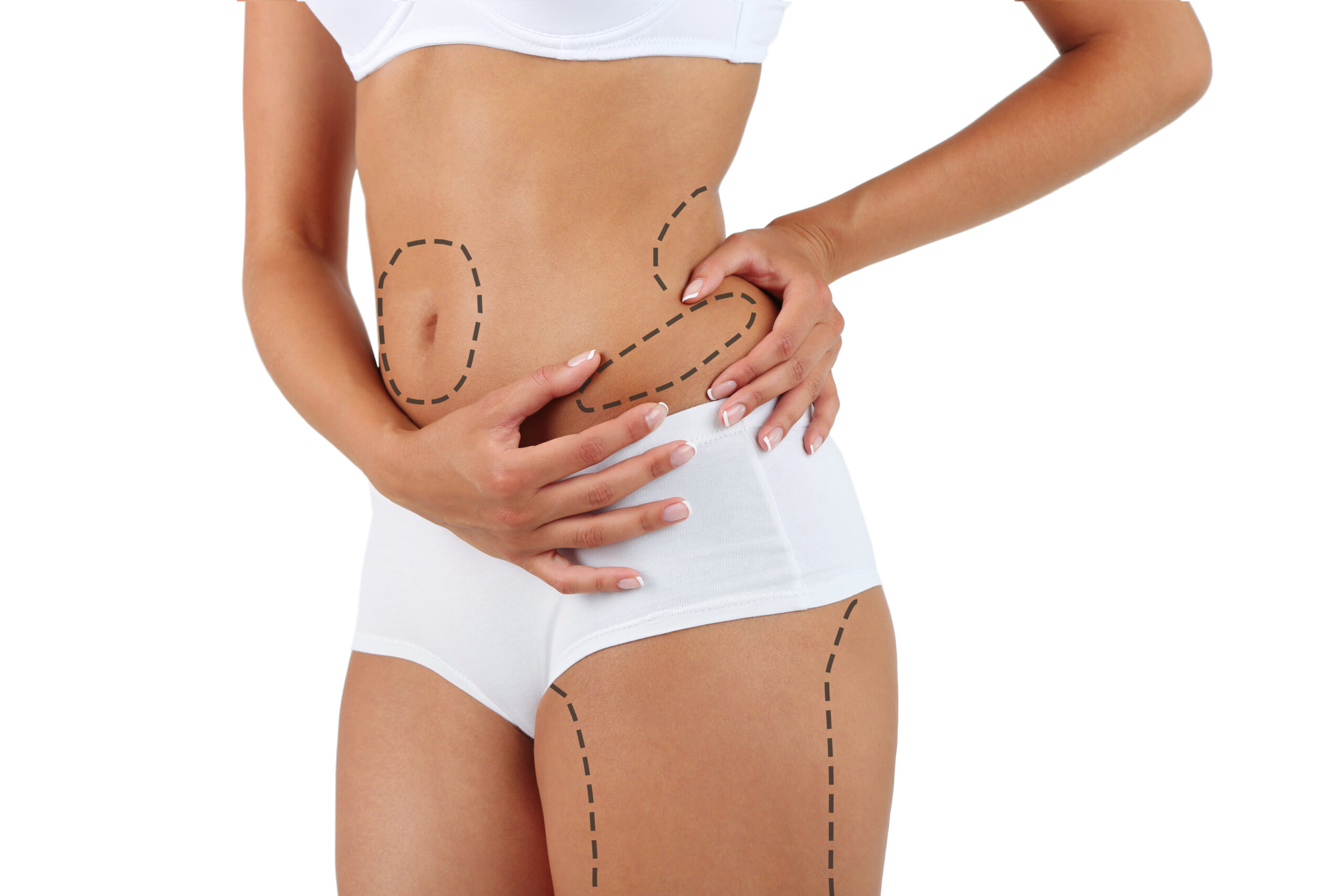 Liposuction (Yağ Aldırma)