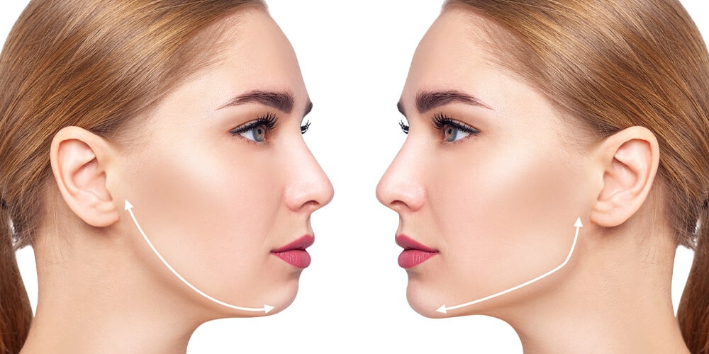 Çene Dolgusu (Jawline)