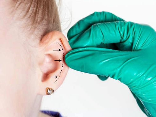 Kepçe Kulak Estetiği (Otoplasti)