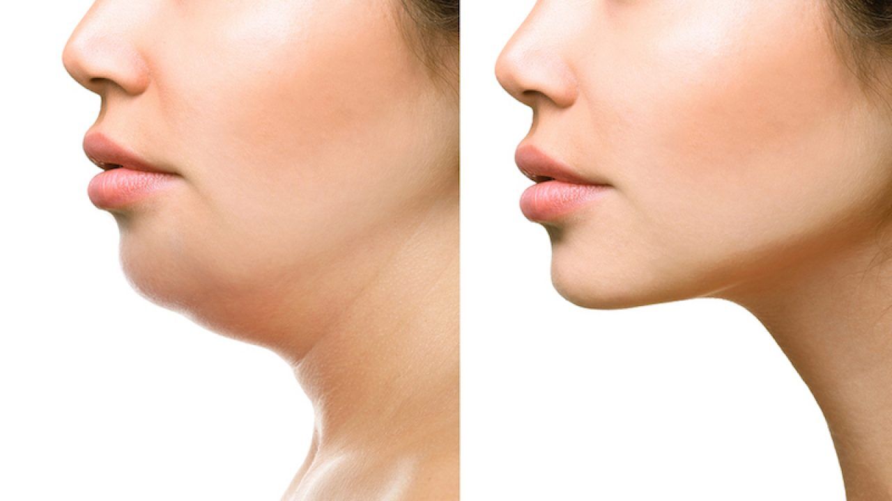 Gıdı Liposuction
