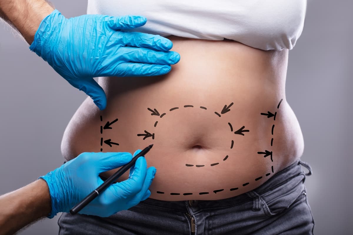 Karın Germe (Abdominoplasti)